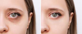 Dark Circle Treatment